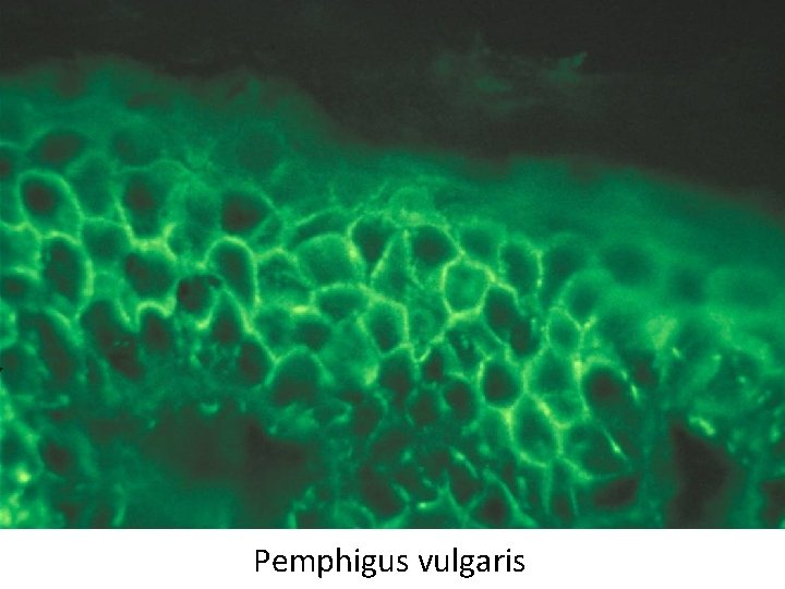 Pemphigus vulgaris 