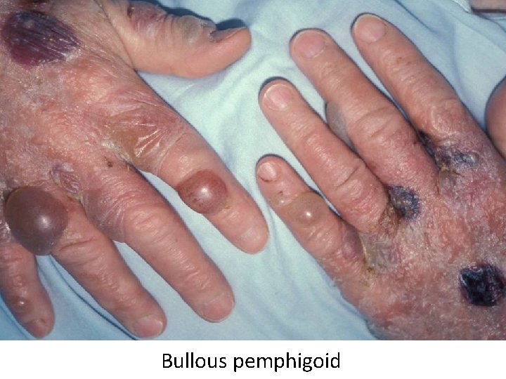 Bullous pemphigoid 