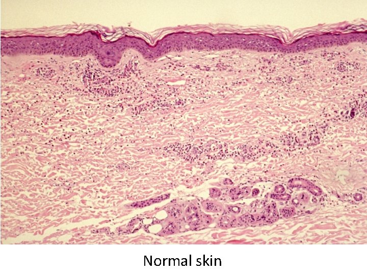 Normal skin 