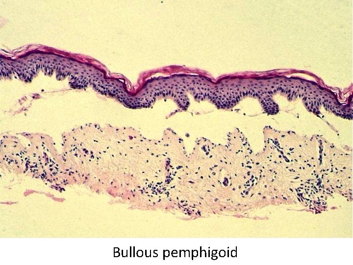 Bullous pemphigoid 