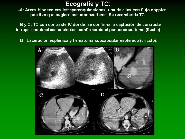 Ecografía y TC: -A: Áreas hipoecoicas intraparenquimatosas, una de ellas con flujo doppler positivo