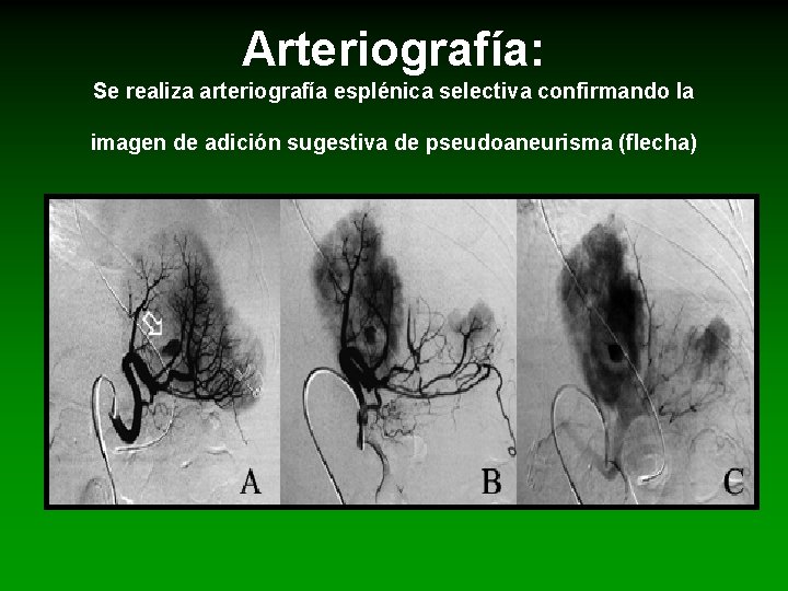 Arteriografía: Se realiza arteriografía esplénica selectiva confirmando la imagen de adición sugestiva de pseudoaneurisma