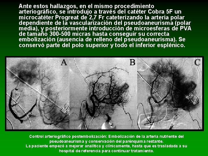 Ante estos hallazgos, en el mismo procedimiento arteriográfico, se introdujo a través del catéter