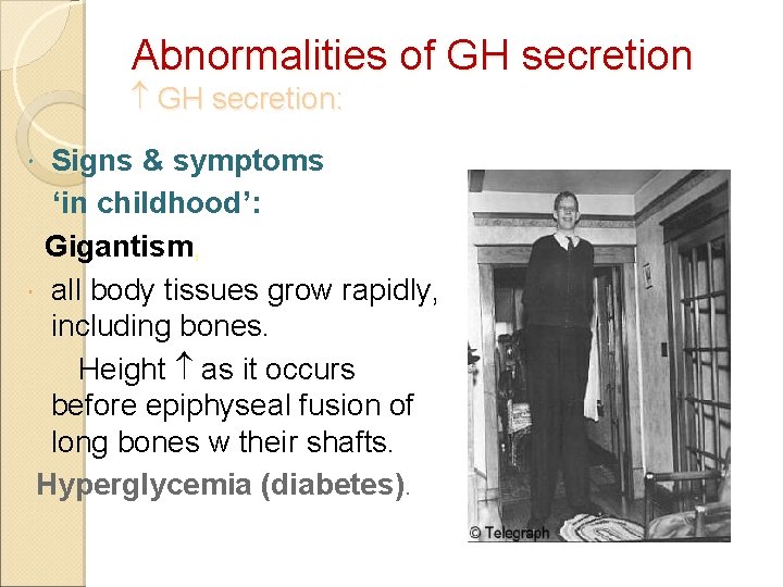 Abnormalities of GH secretion: Signs & symptoms ‘in childhood’: Gigantism, all body tissues grow