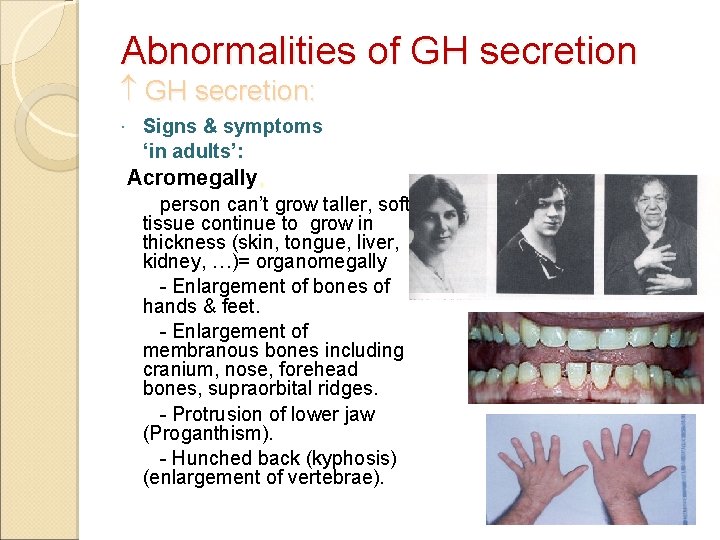 Abnormalities of GH secretion: Signs & symptoms ‘in adults’: Acromegally, person can’t grow taller,
