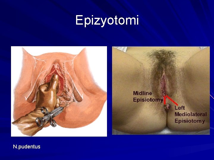 Epizyotomi N. pudentus 