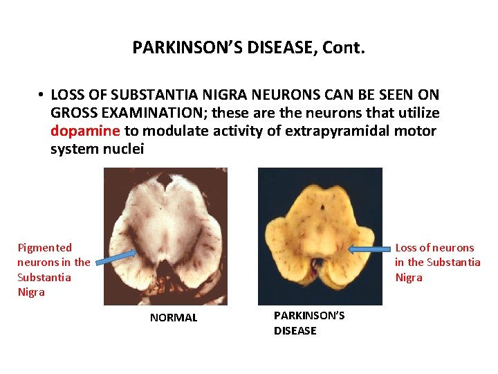 PARKINSON’S DISEASE, Cont. • LOSS OF SUBSTANTIA NIGRA NEURONS CAN BE SEEN ON GROSS PARKINSON’S DISEASE, Cont. • LOSS OF SUBSTANTIA NIGRA NEURONS CAN BE SEEN ON GROSS