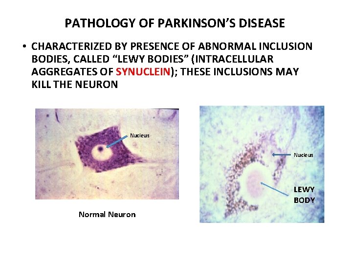 PATHOLOGY OF PARKINSON’S DISEASE • CHARACTERIZED BY PRESENCE OF ABNORMAL INCLUSION BODIES, CALLED “LEWY PATHOLOGY OF PARKINSON’S DISEASE • CHARACTERIZED BY PRESENCE OF ABNORMAL INCLUSION BODIES, CALLED “LEWY