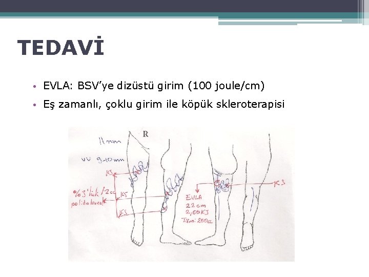 TEDAVİ • EVLA: BSV’ye dizüstü girim (100 joule/cm) • Eş zamanlı, çoklu girim ile