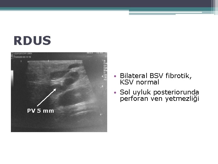 RDUS • Bilateral BSV fibrotik, KSV normal • Sol uyluk posteriorunda perforan ven yetmezliği