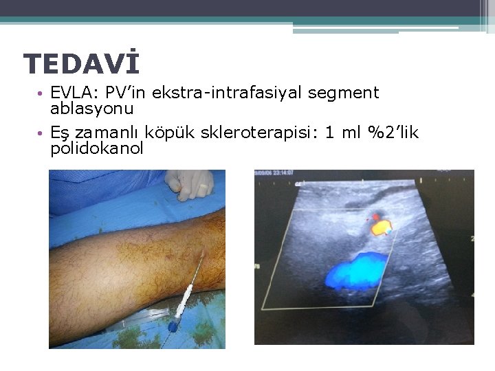 TEDAVİ • EVLA: PV’in ekstra-intrafasiyal segment ablasyonu • Eş zamanlı köpük skleroterapisi: 1 ml