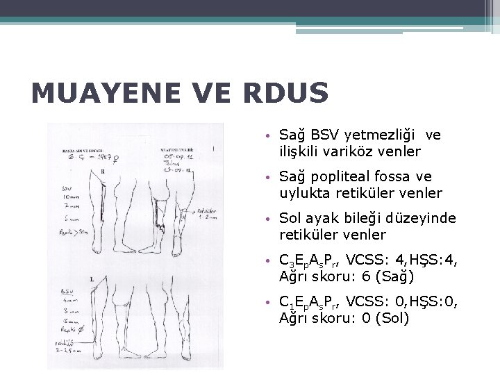 MUAYENE VE RDUS • Sağ BSV yetmezliği ve ilişkili variköz venler • Sağ popliteal