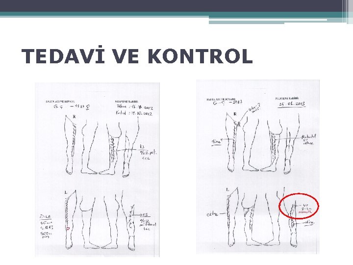 TEDAVİ VE KONTROL 