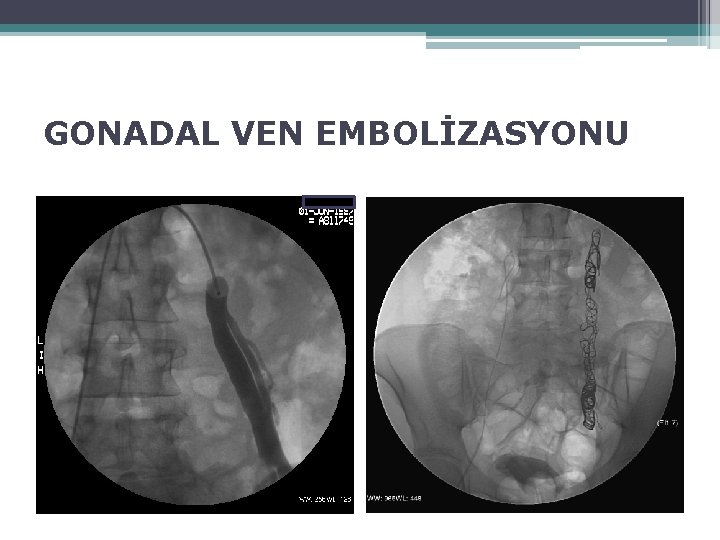 GONADAL VEN EMBOLİZASYONU 