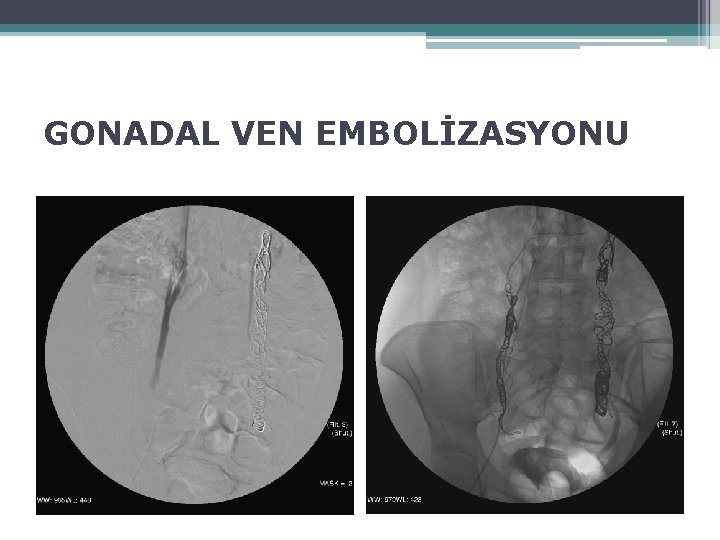 GONADAL VEN EMBOLİZASYONU 