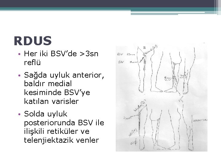 RDUS • Her iki BSV’de >3 sn reflü • Sağda uyluk anterior, baldır medial