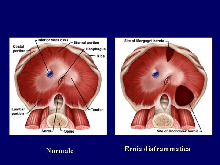 Normale Ernia diaframmatica 