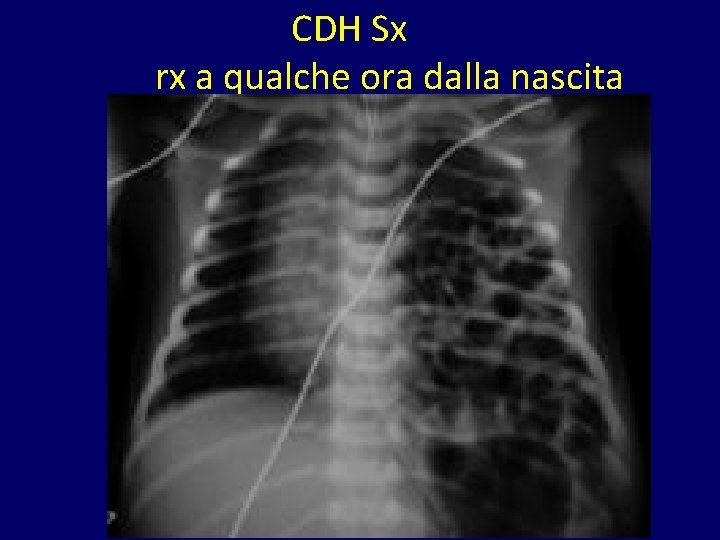 CDH Sx rx a qualche ora dalla nascita 