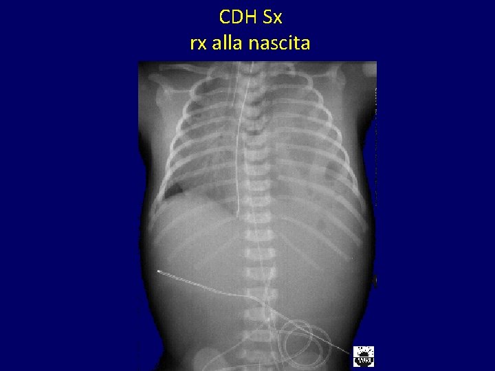 CDH Sx rx alla nascita 