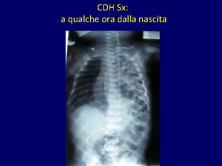 CDH Sx: a qualche ora dalla nascita 