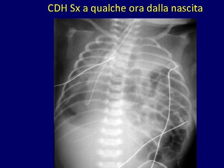 CDH Sx a qualche ora dalla nascita 