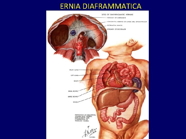 ERNIA DIAFRAMMATICA 