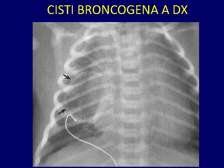 CISTI BRONCOGENA A DX 