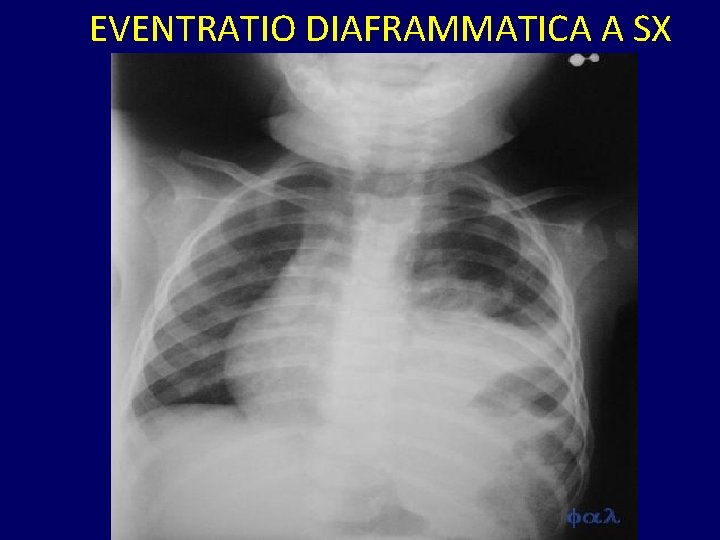 EVENTRATIO DIAFRAMMATICA A SX 