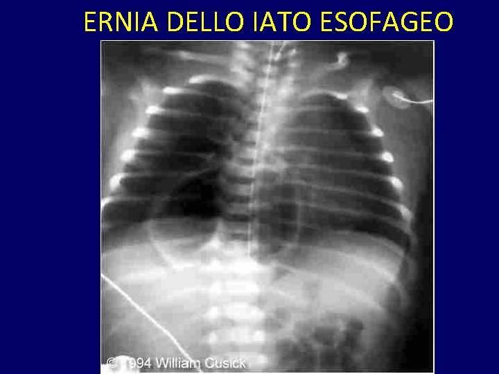 ERNIA DELLO IATO ESOFAGEO 