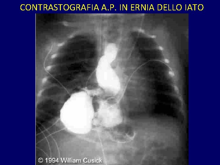 CONTRASTOGRAFIA A. P. IN ERNIA DELLO IATO 