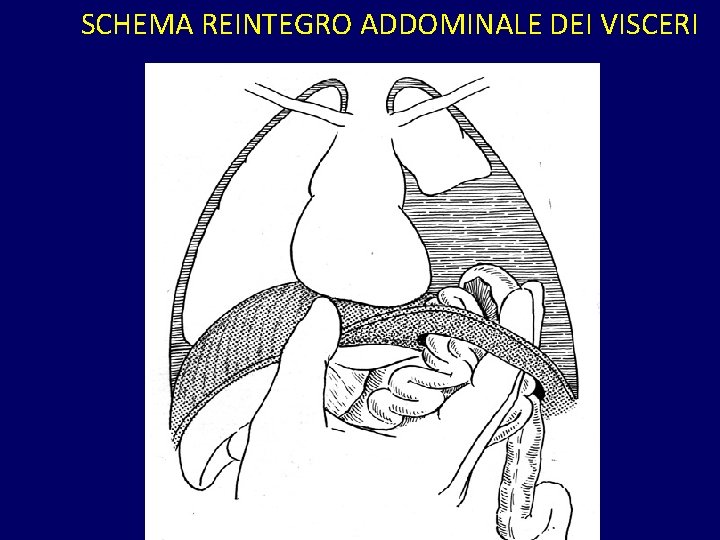 SCHEMA REINTEGRO ADDOMINALE DEI VISCERI 