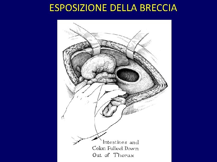 ESPOSIZIONE DELLA BRECCIA 