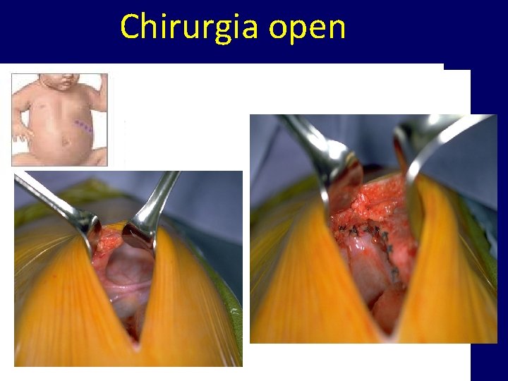 Chirurgia open 