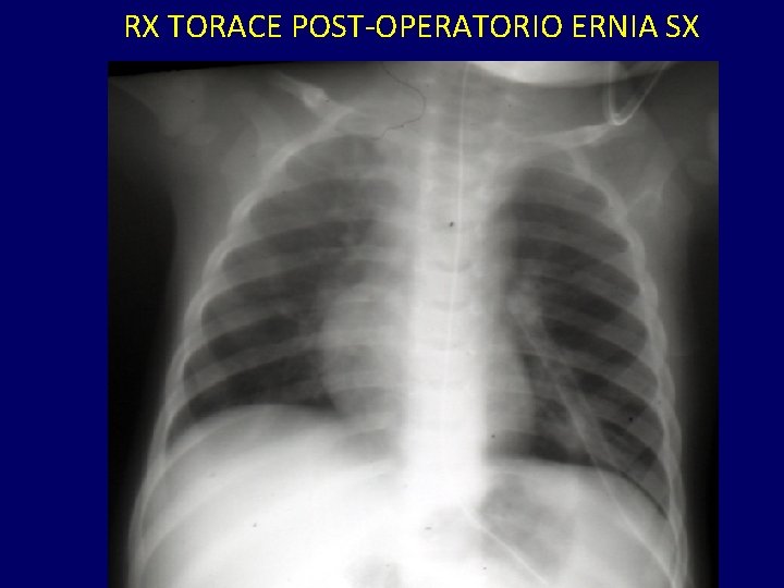 RX TORACE POST-OPERATORIO ERNIA SX 