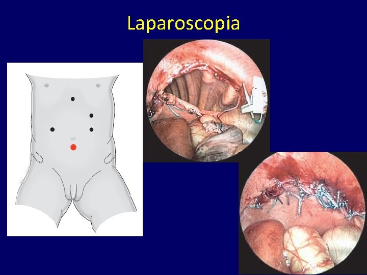 Laparoscopia 