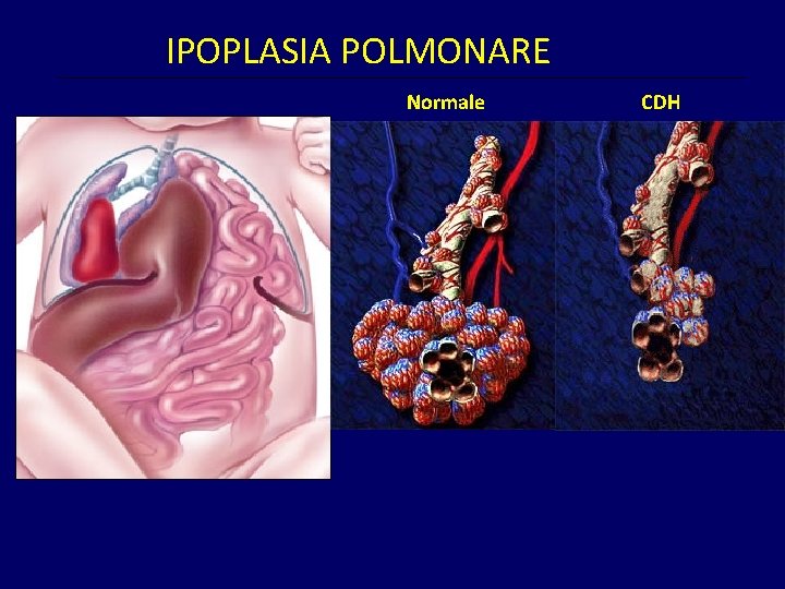 IPOPLASIA POLMONARE Normale CDH 