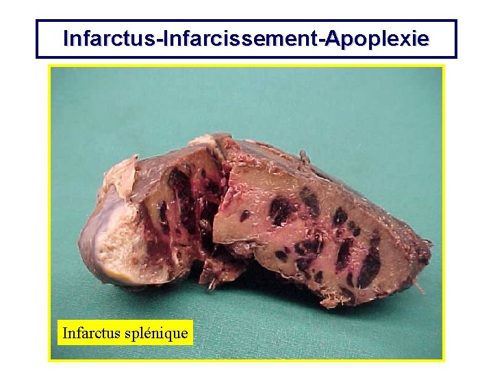 Infarctus-Infarcissement-Apoplexie Infarctus splénique 