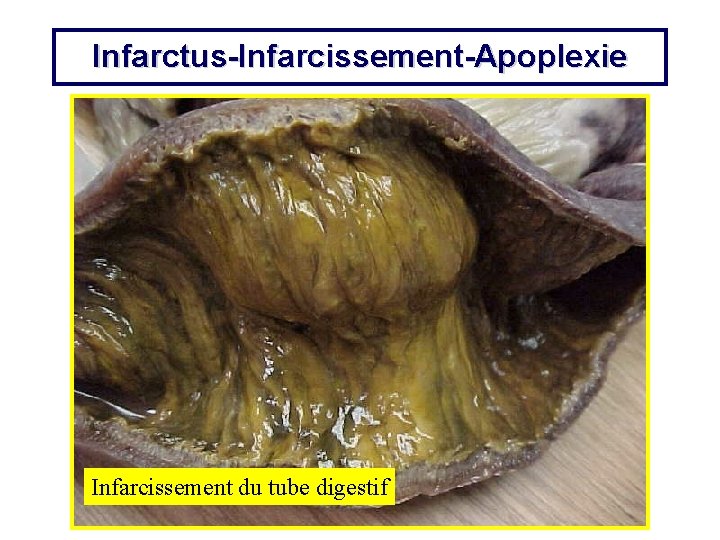 Infarctus-Infarcissement-Apoplexie Infarcissement du tube digestif 