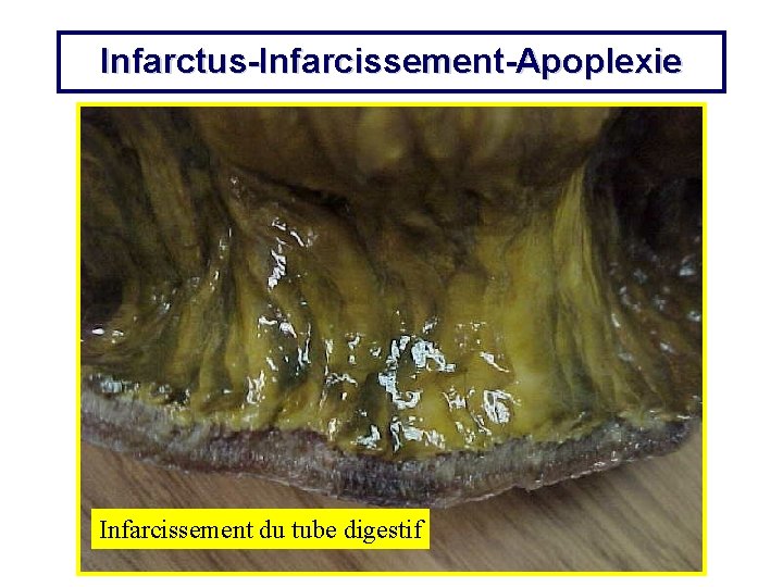 Infarctus-Infarcissement-Apoplexie Infarcissement du tube digestif 