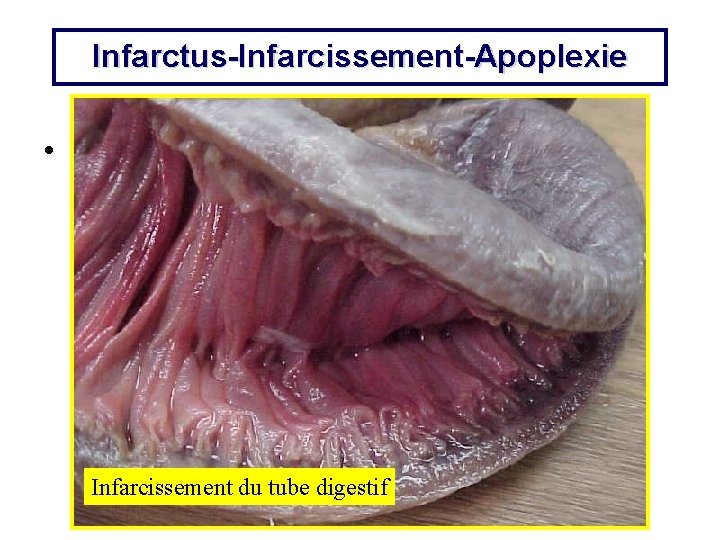 Infarctus-Infarcissement-Apoplexie • G: INFARC-1. JPG Infarcissement du tube digestif 