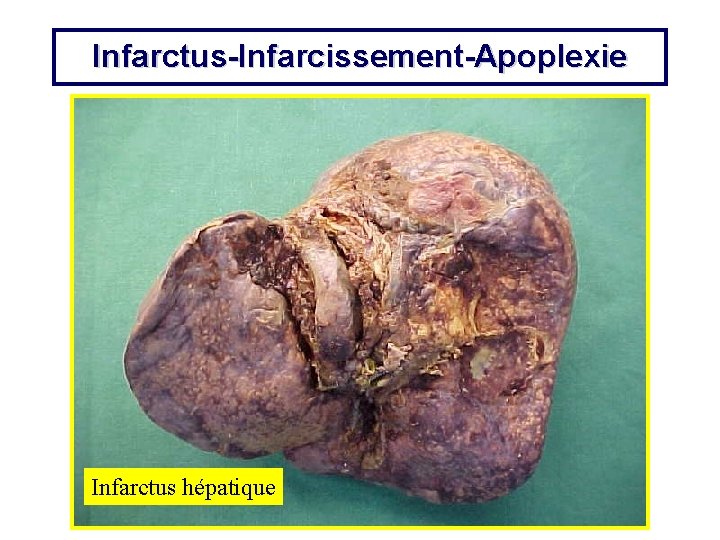Infarctus-Infarcissement-Apoplexie Infarctus hépatique 