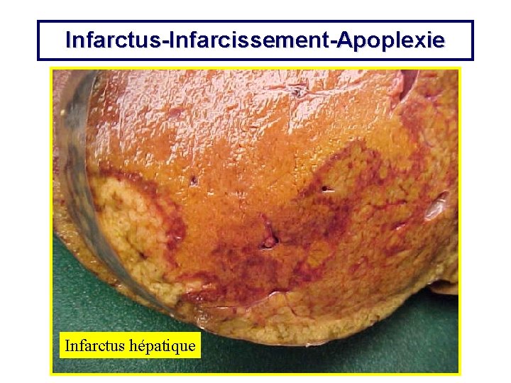 Infarctus-Infarcissement-Apoplexie Infarctus hépatique 