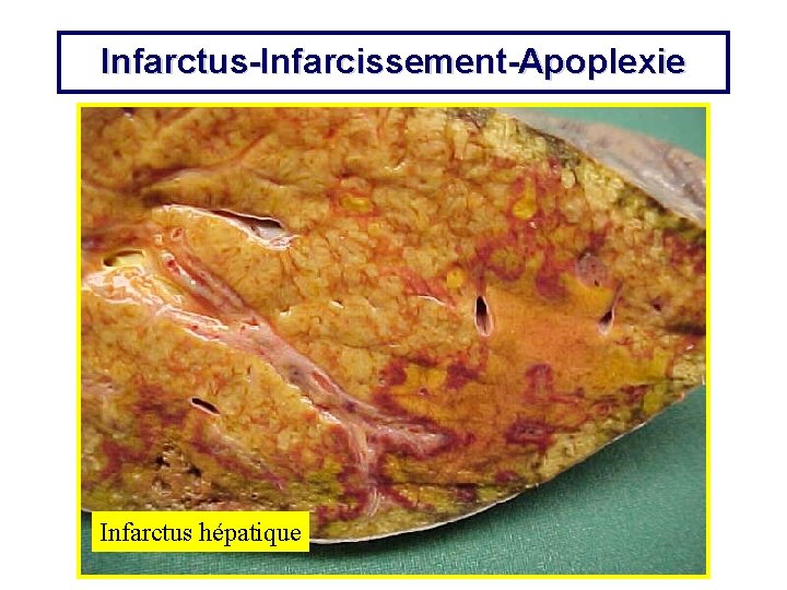 Infarctus-Infarcissement-Apoplexie Infarctus hépatique 