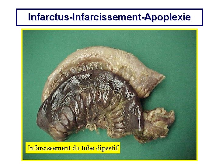 Infarctus-Infarcissement-Apoplexie Infarcissement du tube digestif 