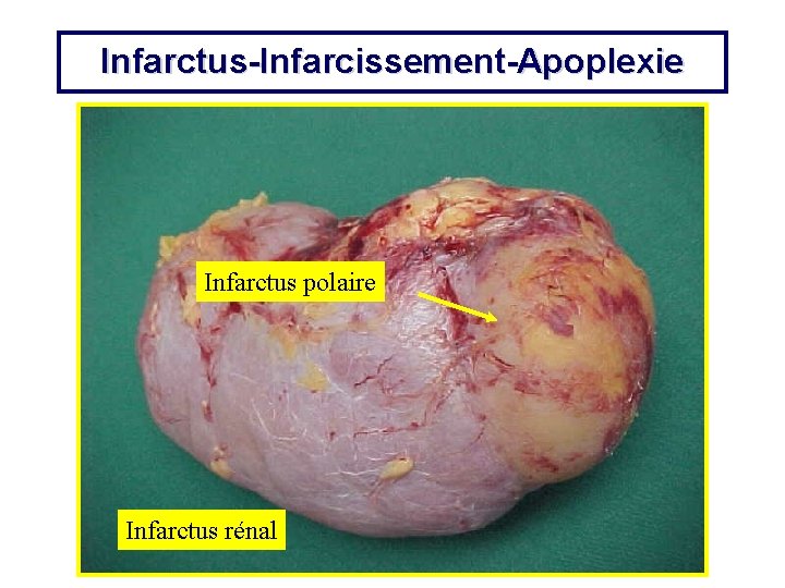 Infarctus-Infarcissement-Apoplexie Infarctus polaire Infarctus rénal 