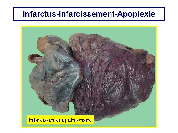 Infarctus-Infarcissement-Apoplexie Infarcissement pulmonaire 
