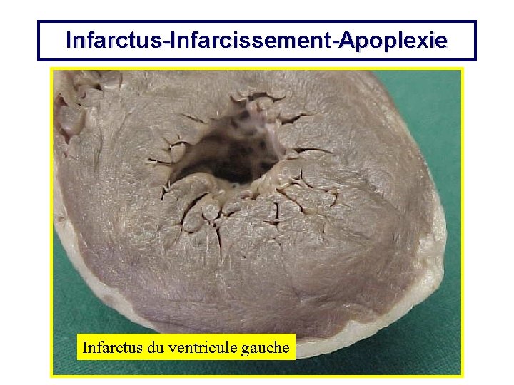 Infarctus-Infarcissement-Apoplexie Infarctus du ventricule gauche 