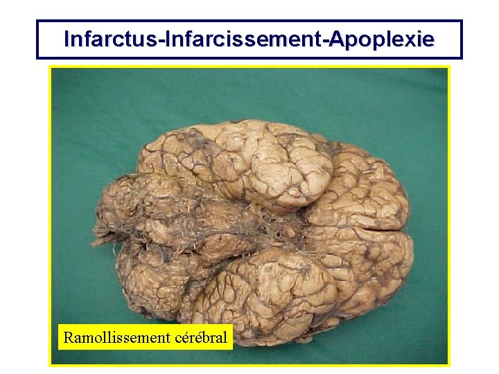 Infarctus-Infarcissement-Apoplexie Ramollissement cérébral 