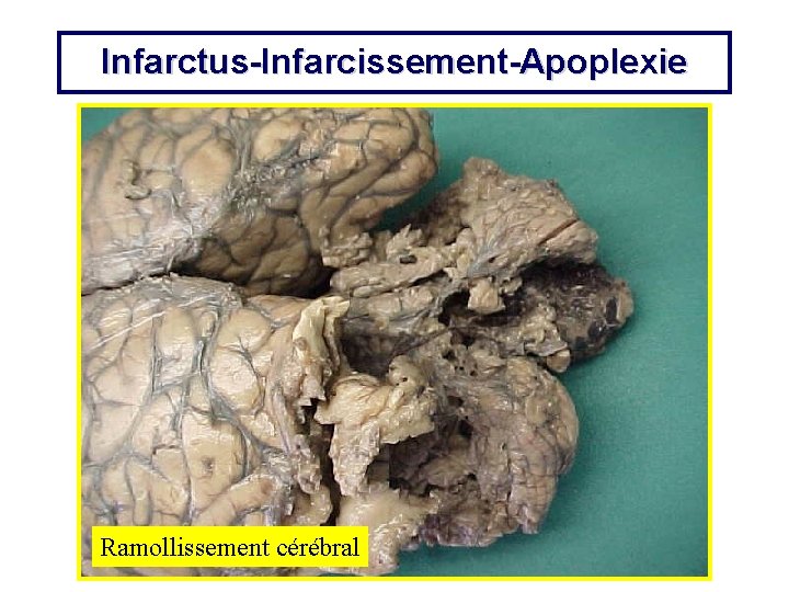 Infarctus-Infarcissement-Apoplexie Ramollissement cérébral 