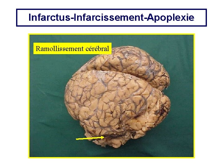 Infarctus-Infarcissement-Apoplexie Ramollissement cérébral 